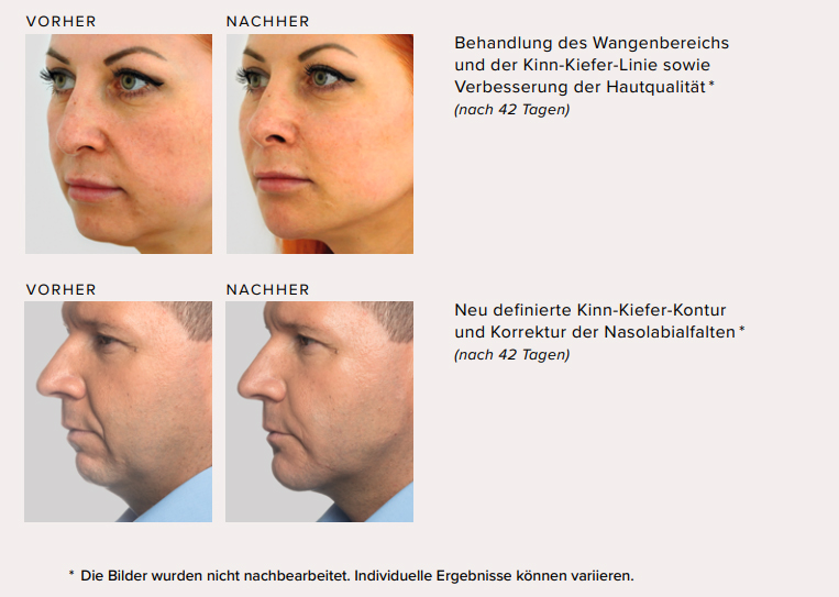 Radiesse Vorher Nachher